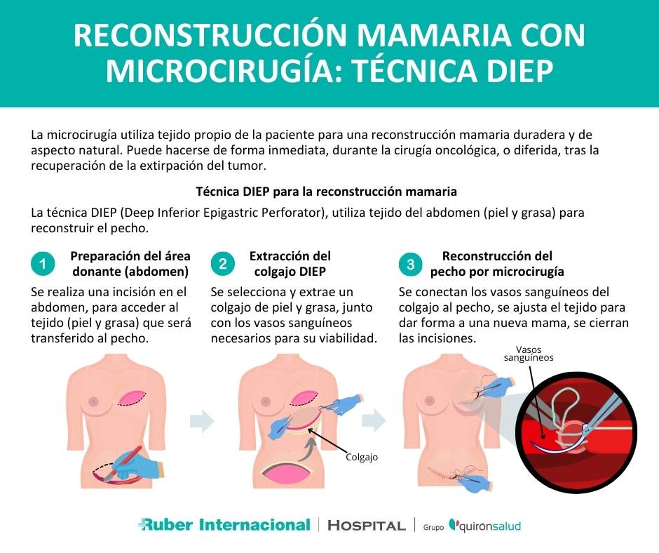 reconstruccion mamaria autologa tejidos propios DIEP