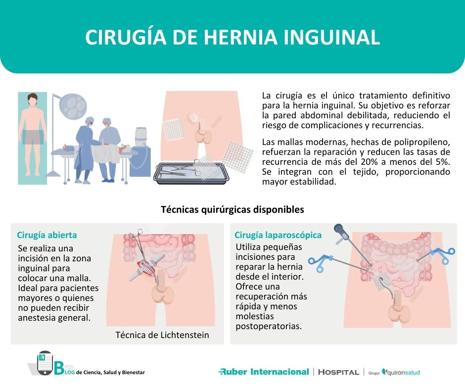 Cirugía de la Hernia Inguinal