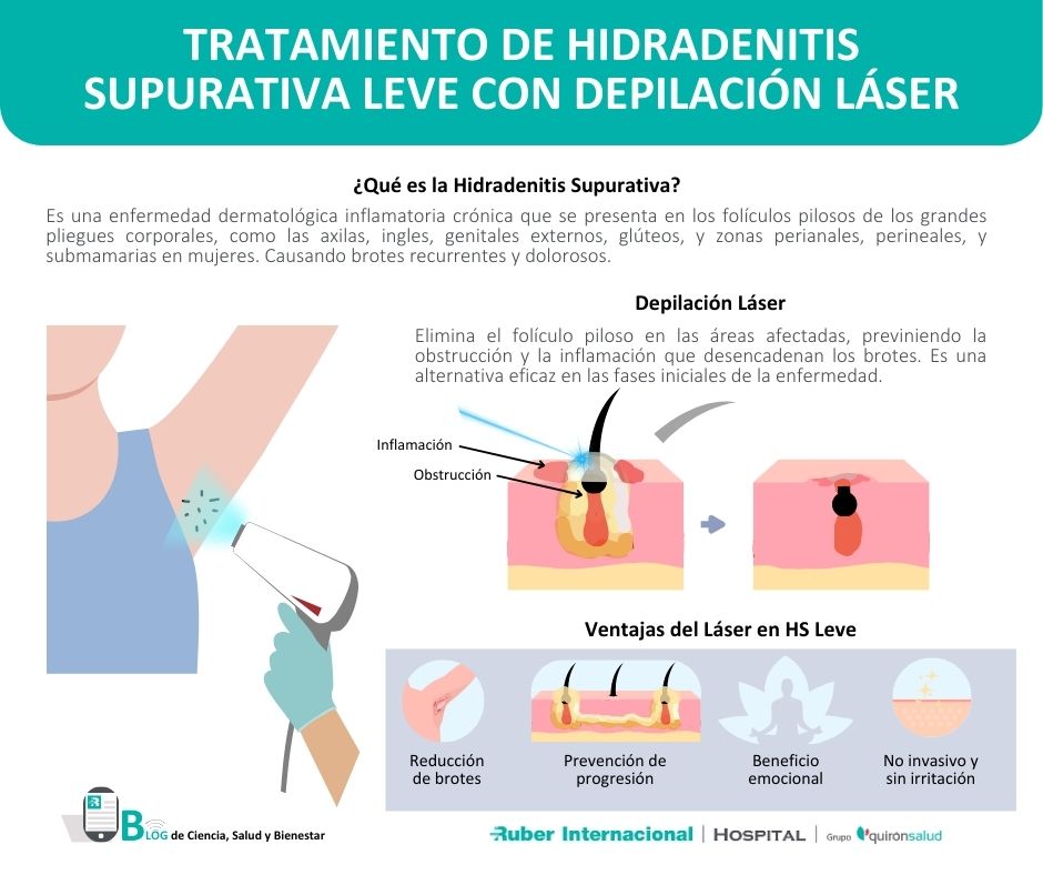 tratamiento hidradenitis supurativa depilacion laser