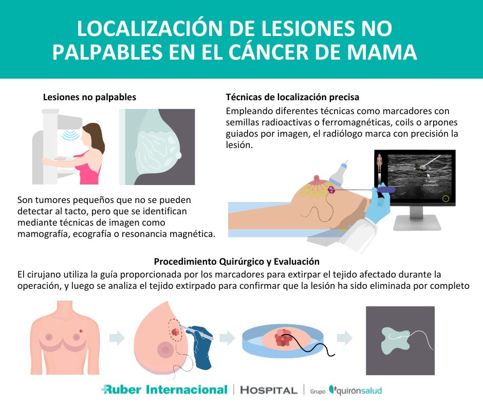 cirugia del cancer de mama lesiones no palpables