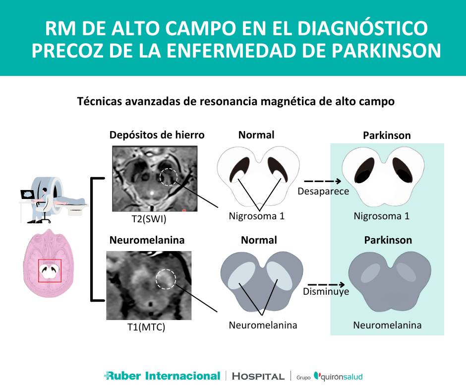 Parkinson Resonancia Diagnostico