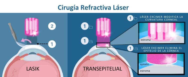 cirugía láser transepitelial excimer