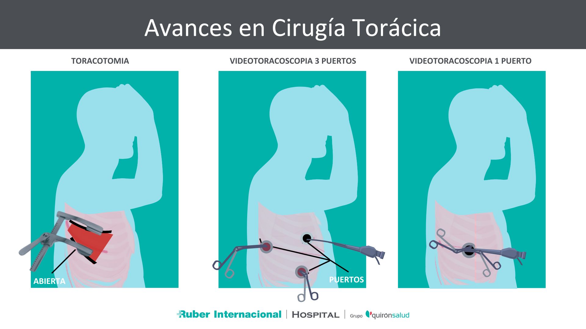 Cirugía Torácica minimamente invasiva Videotoracoscopia