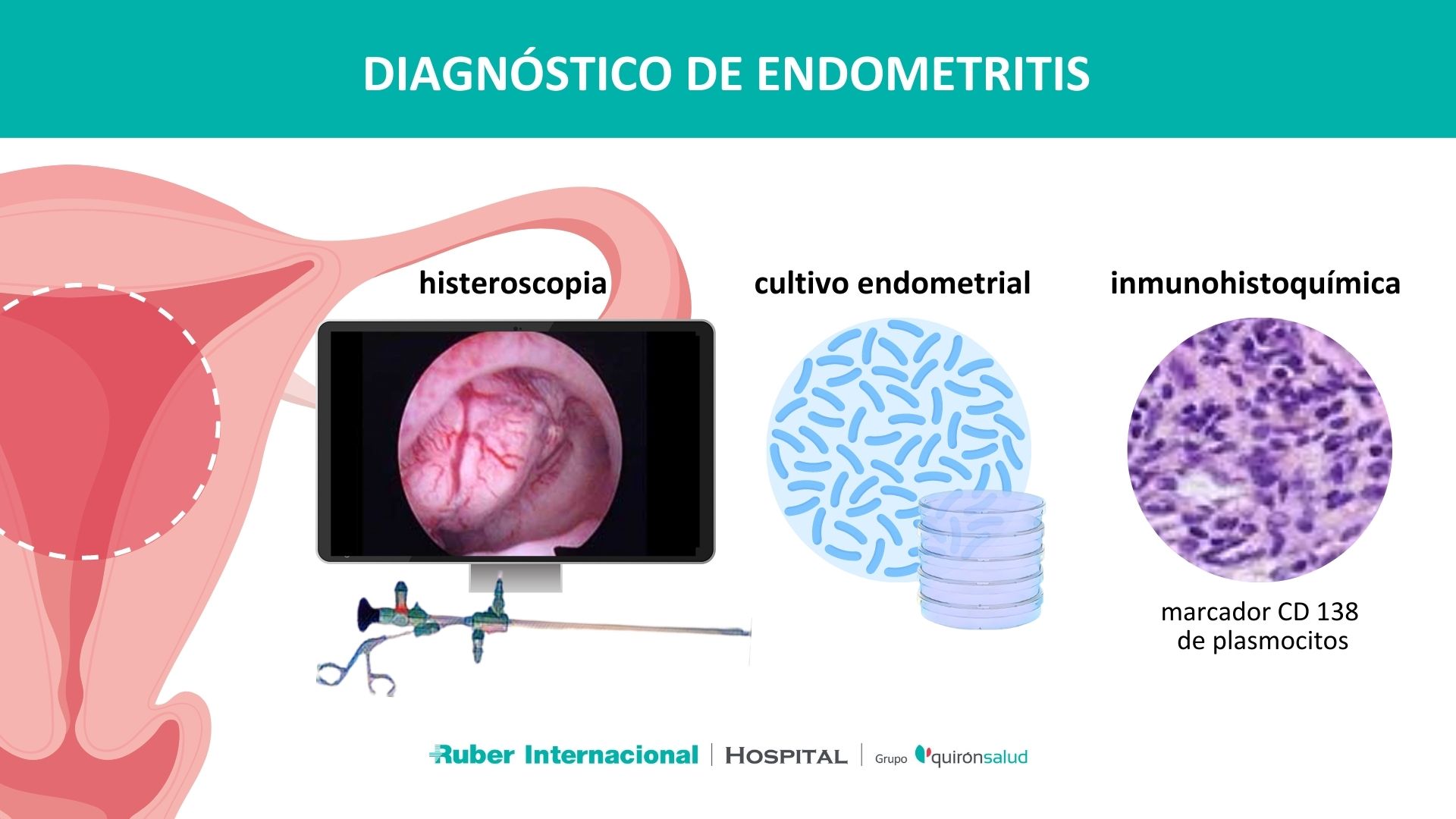 Evaluación del Endometrio en el fallo de implantación y endometritis