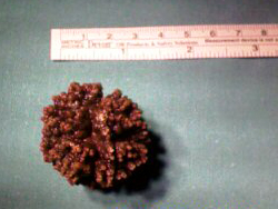 Piedra-de-3-cm-riñon