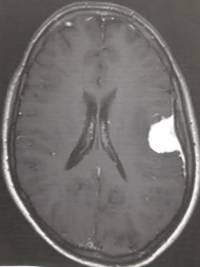 meningioma