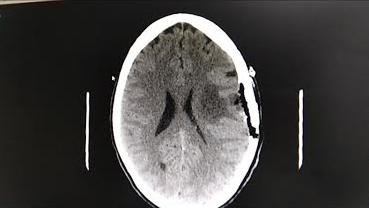 meningioma