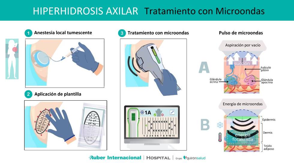 Tratamiento efectivo de la Hiperhidrosis Sudoración excesiva con miraDRY