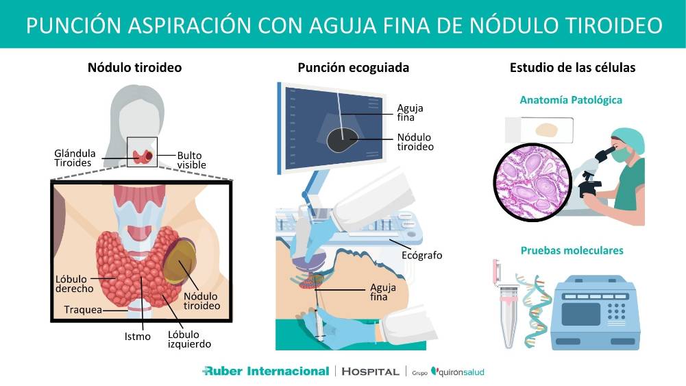 Punción Aspiración por Aguja Fine PAFF nódulo Tiroideo Hospital Ruber Internacional