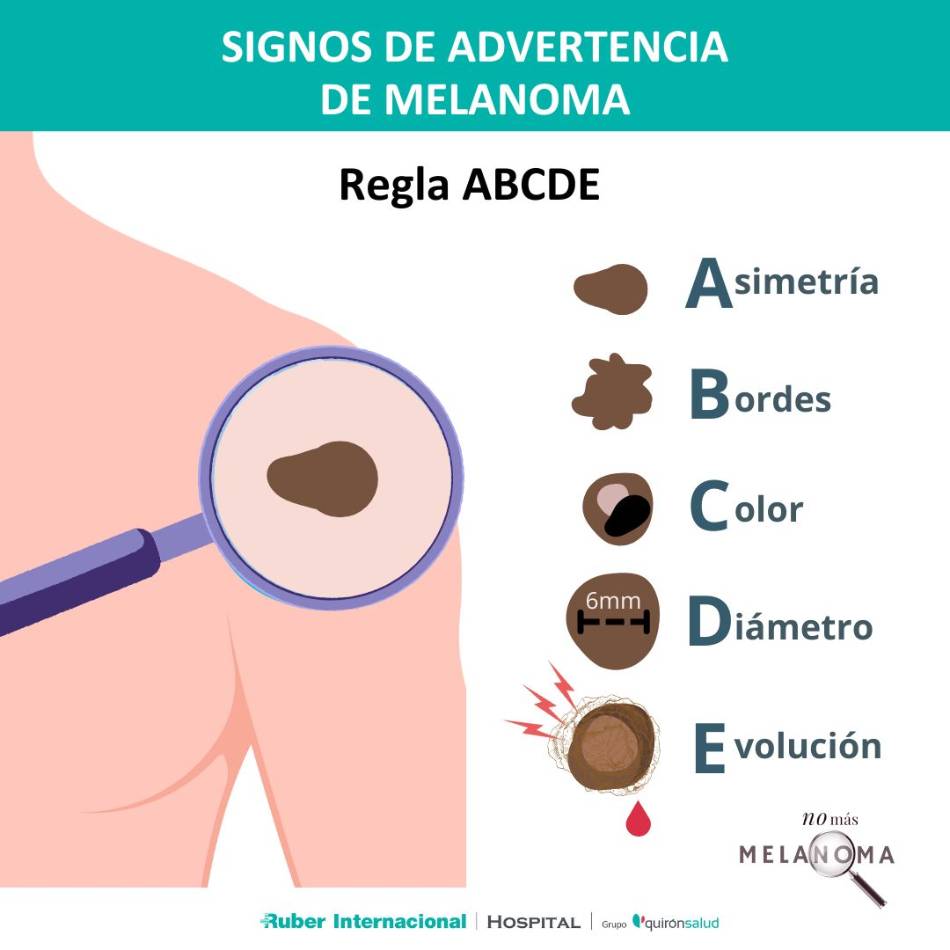 Prevención del Melanoma La regla ABCDE