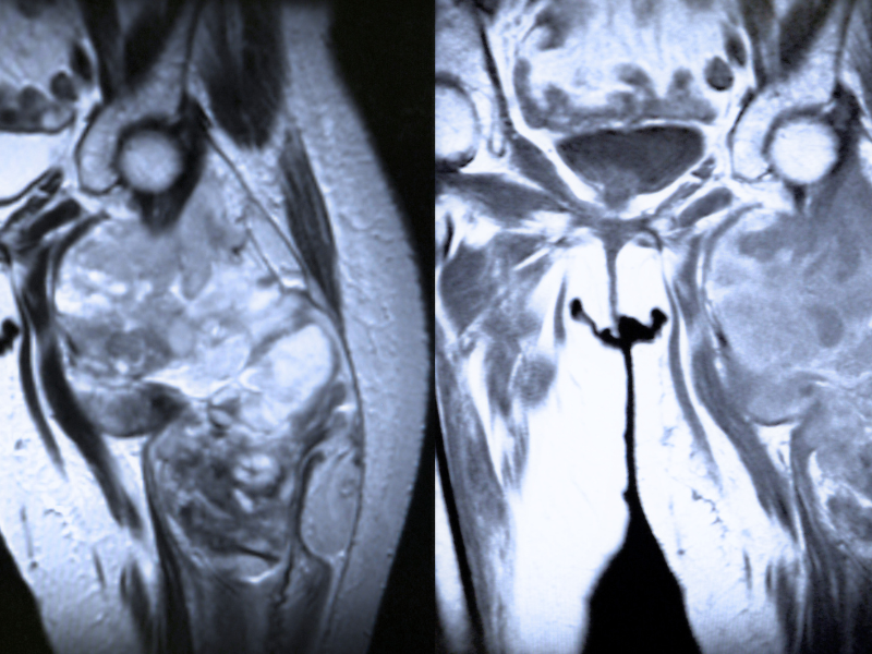 Especialistas en sarcoma