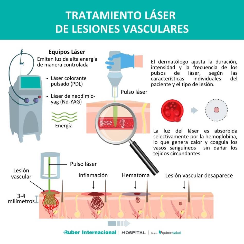 Láser Vascular en el tratamiento de lesiones vasculares