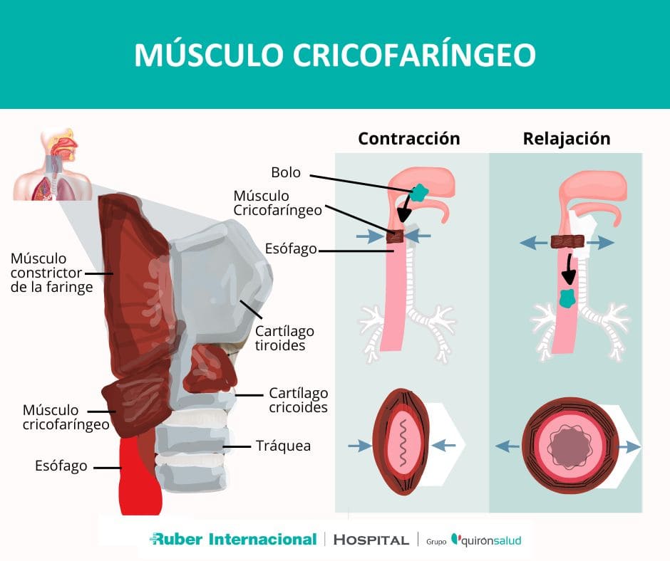 disfagia disfuncion músculo cricofaríngeo