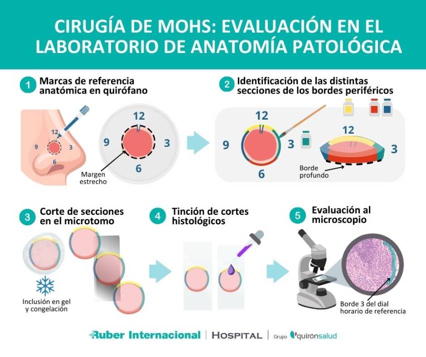 evaluación en laboratorio cirugía de mohs tratamiento carcinoma basocelular (1)