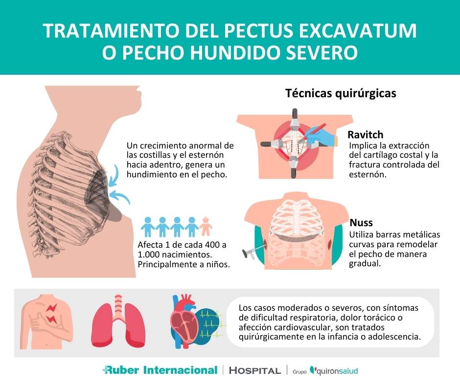 tratamiento del pectus excavatum o pecho hundido (1)