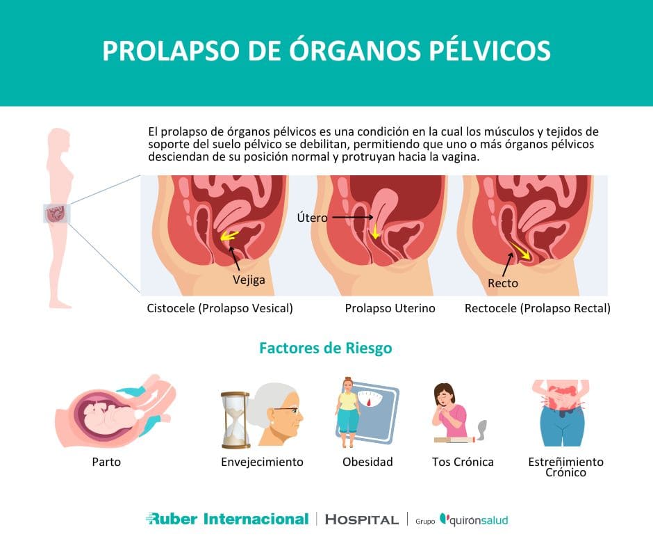 Prolapso de órganos pélvicos factores de riesgo