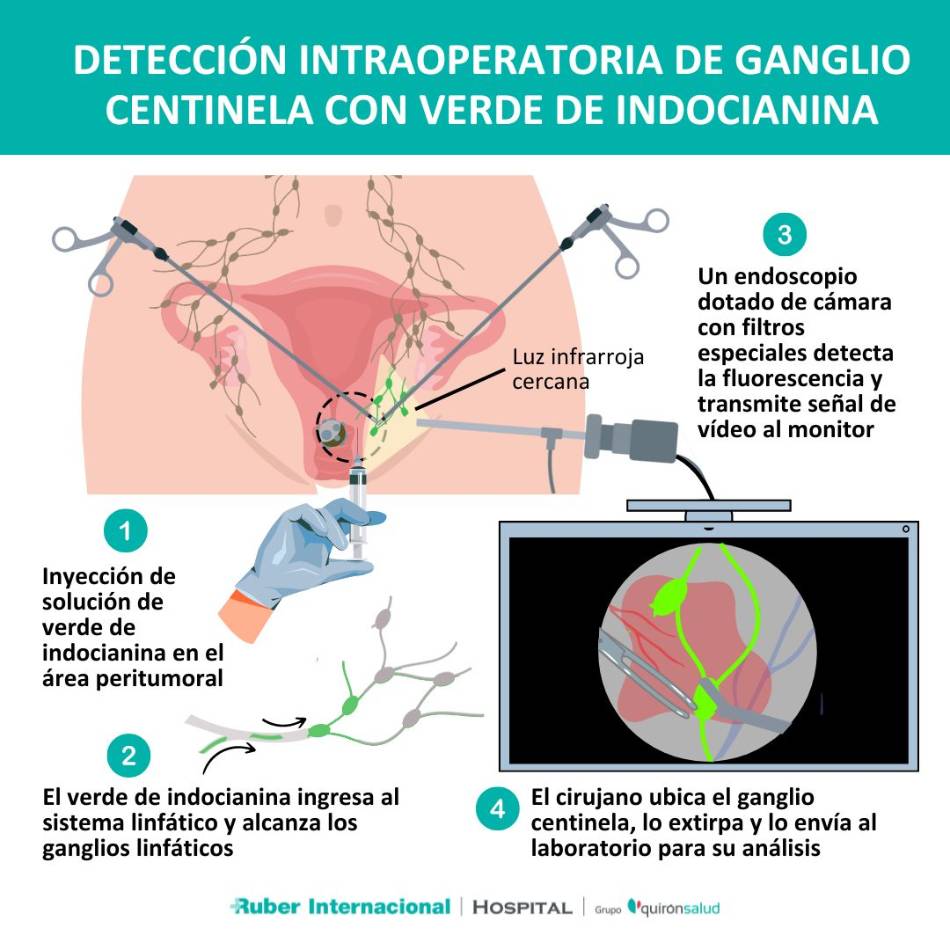 Biopsia de ganglio centinela verde de indocianina