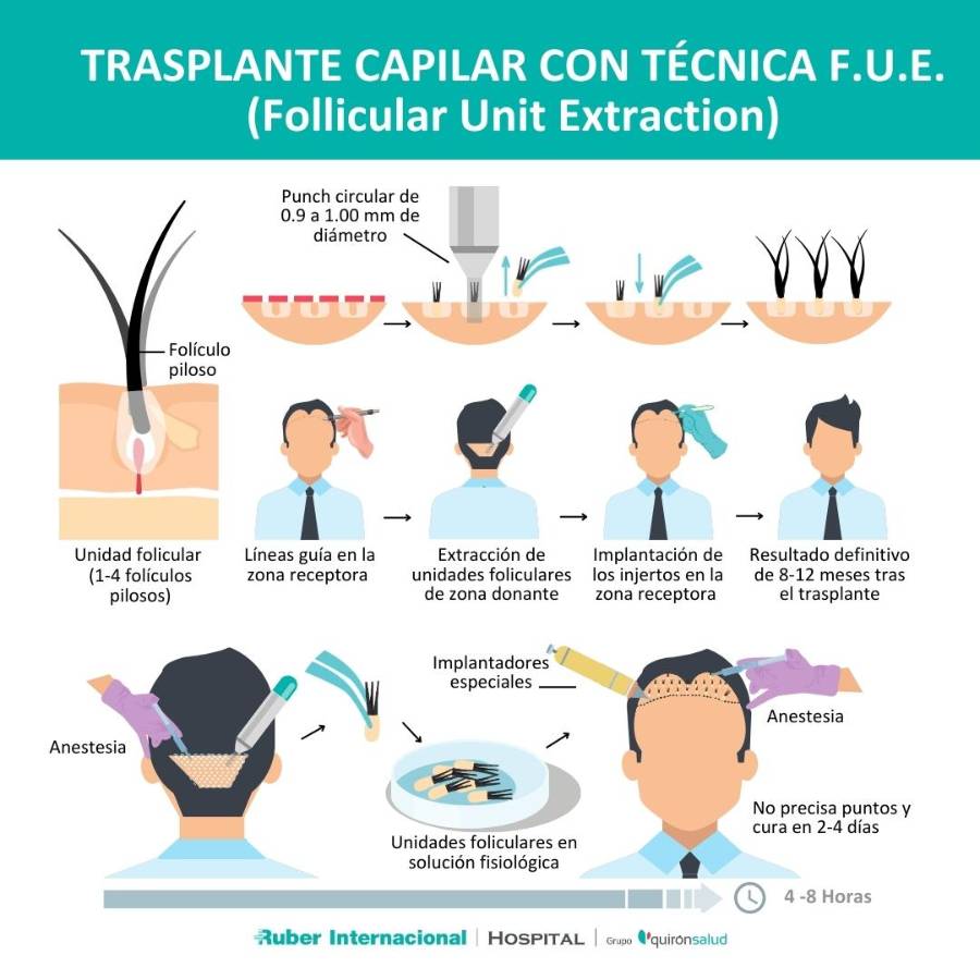 FUE Trasplante capilar para la alopecia