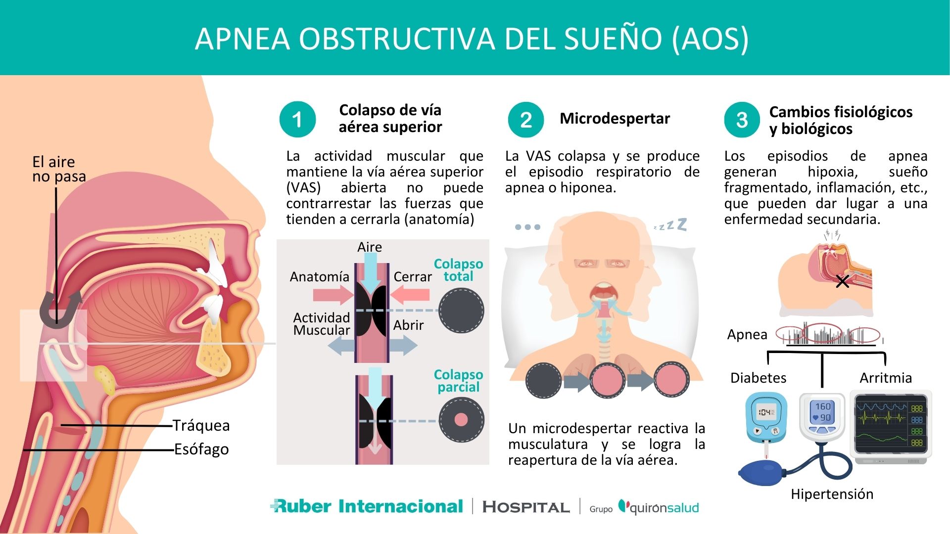 Apnea obstructiva del sueño-Causas y consecuencias