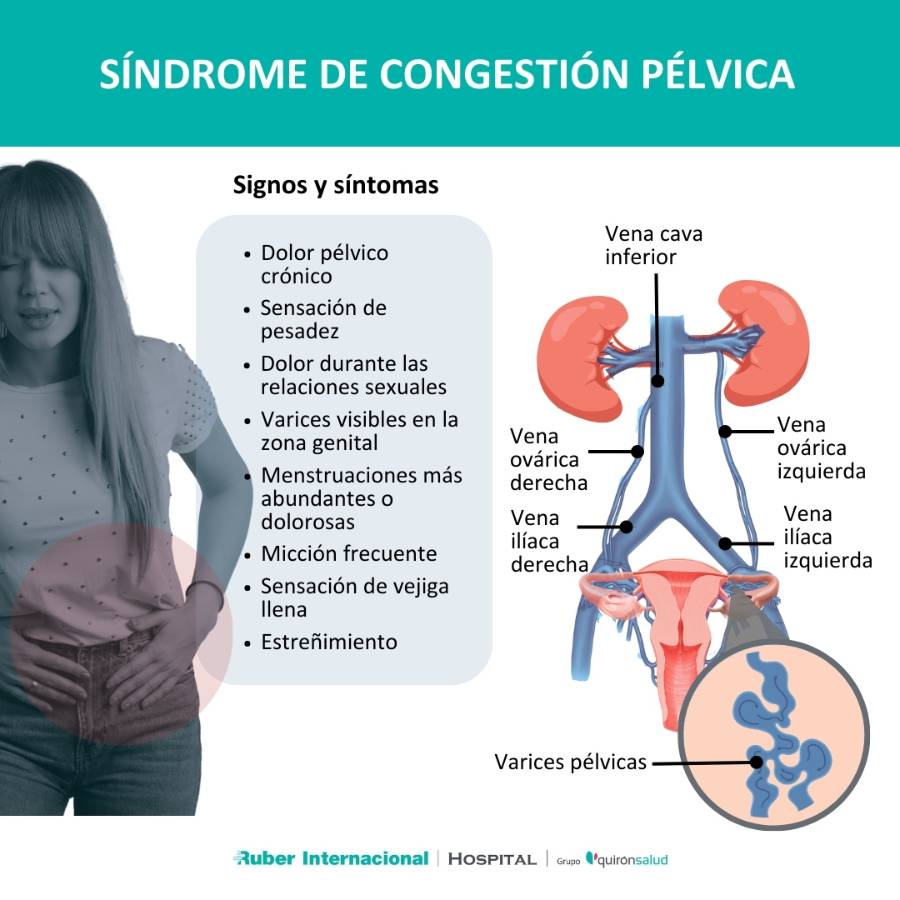 Varices pélvicas Síndrome de congestión pélvica