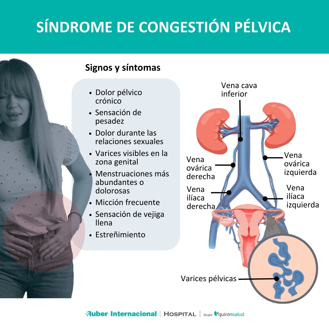 Varices pélvicas Síndrome de congestión pélvica