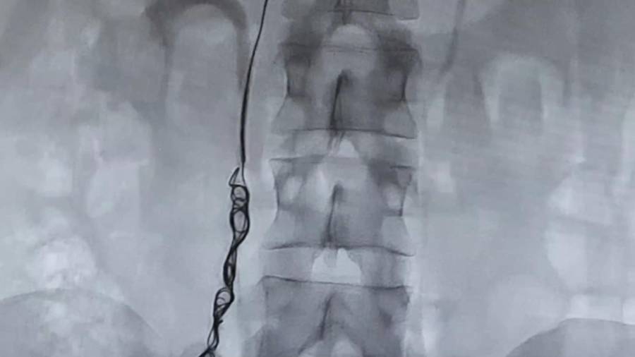 Embolización de varices pélvicas