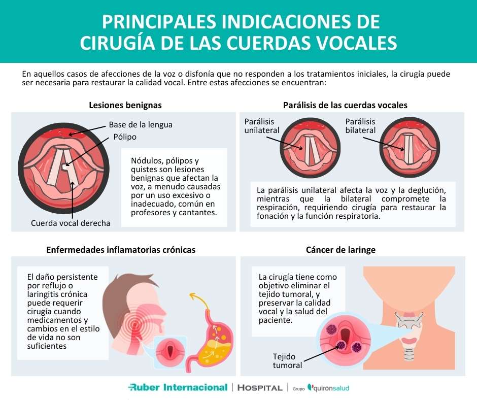 Problemas de la voz que requieren cirugía de las cuerdas vocales o cirugia de la voz