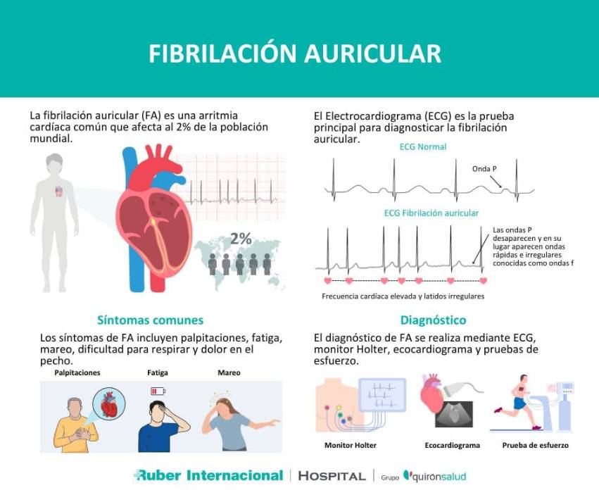 Que es sintoma diagnostico fibrilacion auricular