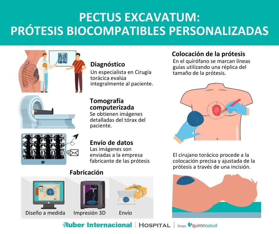 tratamiento del pectus protesis biocompatibles pecho hundido