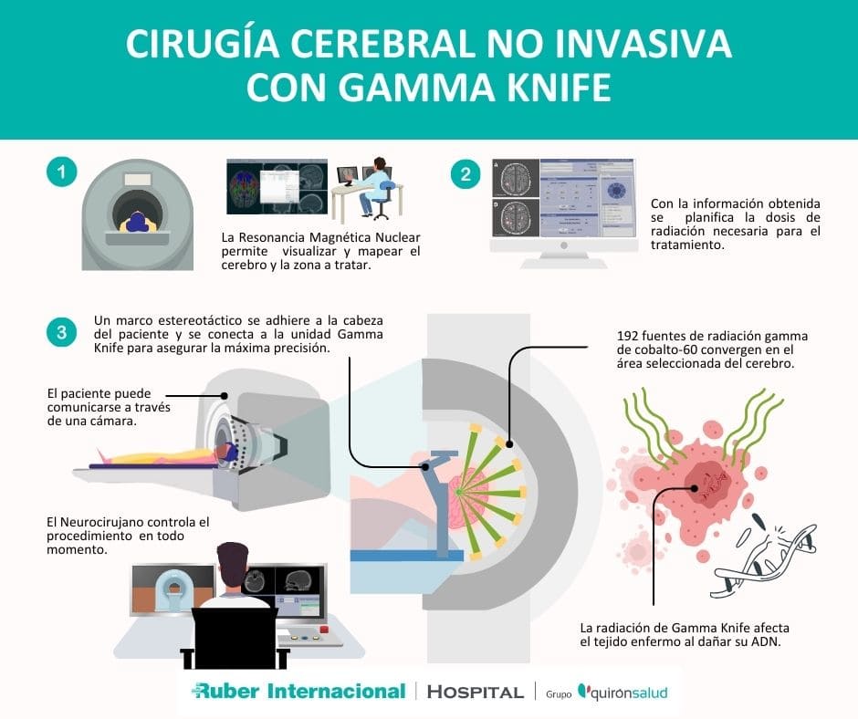 Cirugia cerebral gamma knife ruber internacional