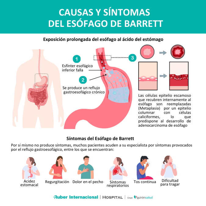 Causas y Síntomas del Esófago de Barrett