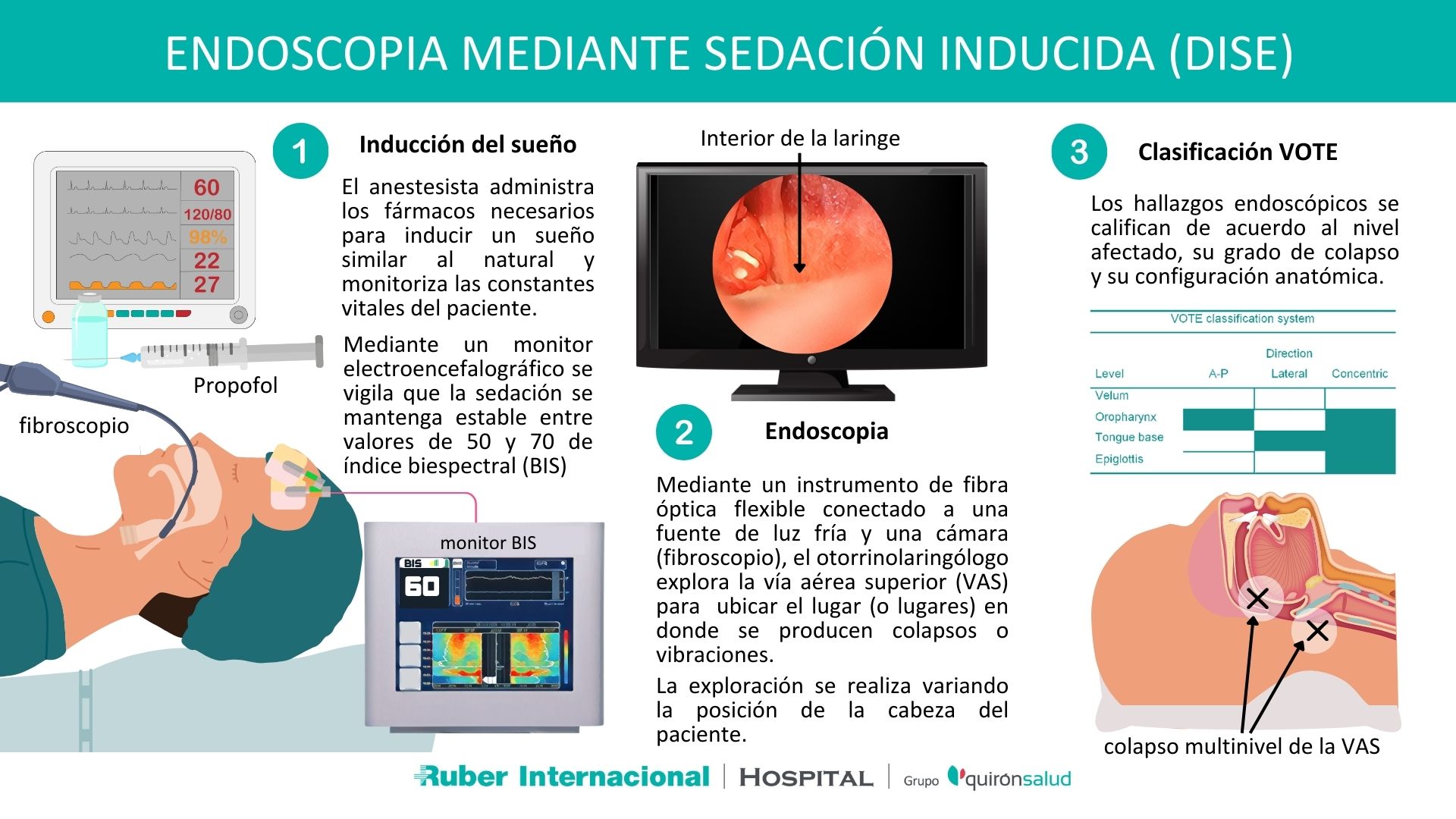 Endoscopia mediante sedación inducida DISE para diagnóstico de apnea del sueño