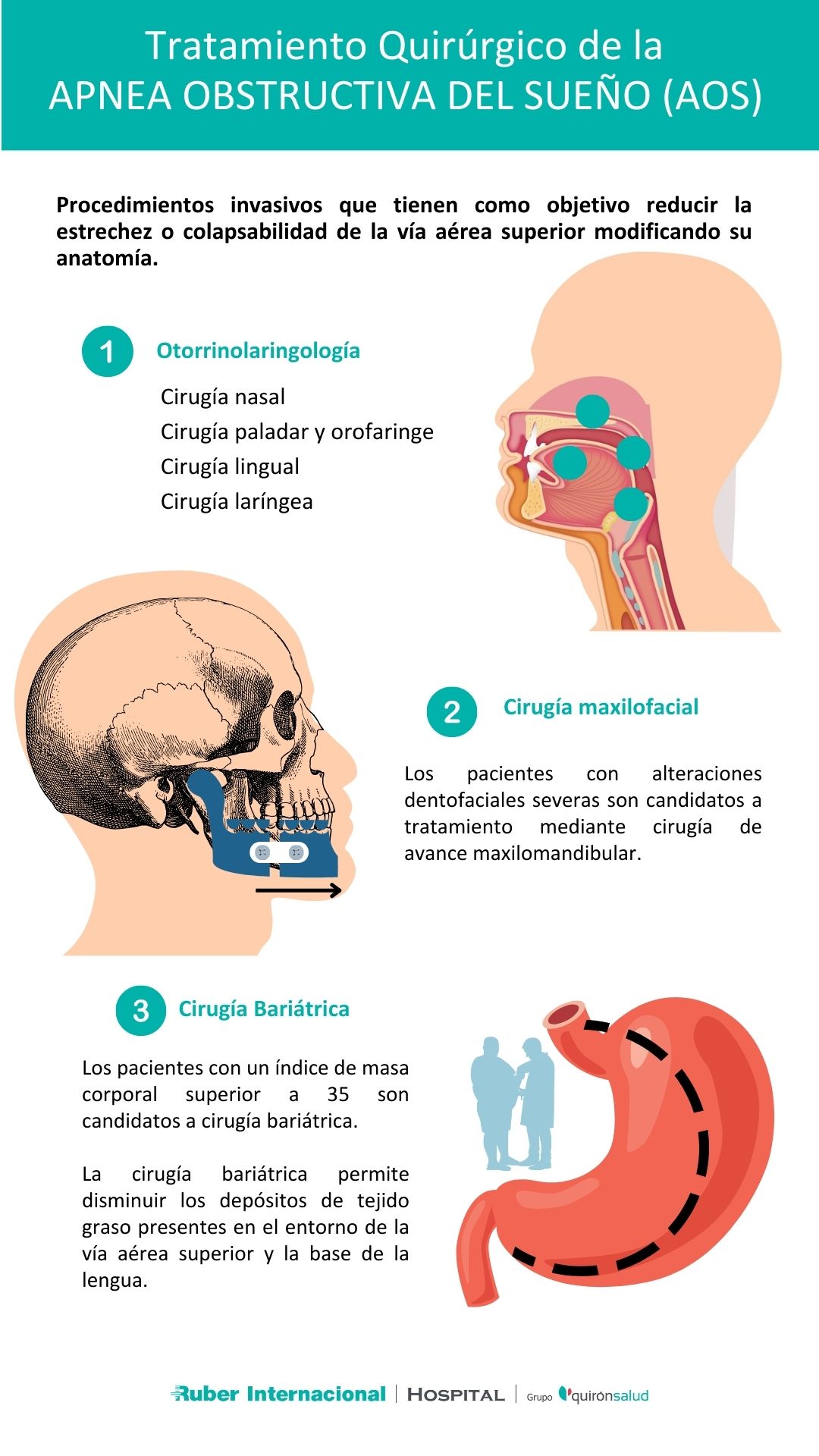 Tratamiento quirúrgico de la apnea obstructiva del sueño en Hospital Ruber Internacional