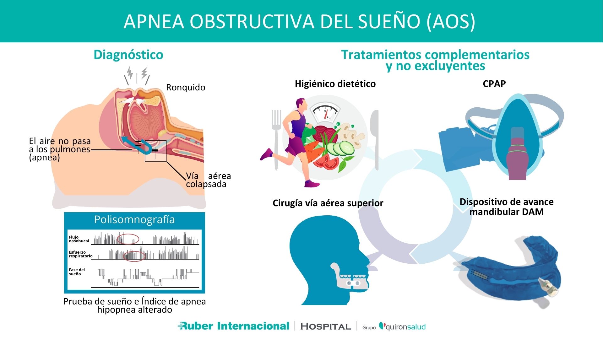 Tratamiento de la Apnea obstructiva del sueño AOS