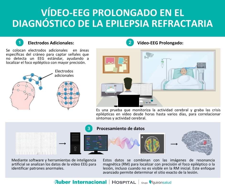 epilepsia refractaria diagnostico video eeg