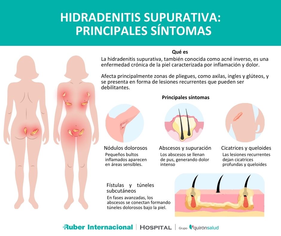 Sintomas Hidradenitis Supurativa