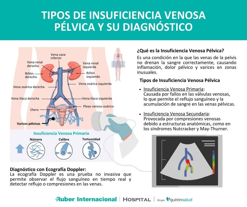 diagnostico insuficiencia venosa pelvica ecografia doppler