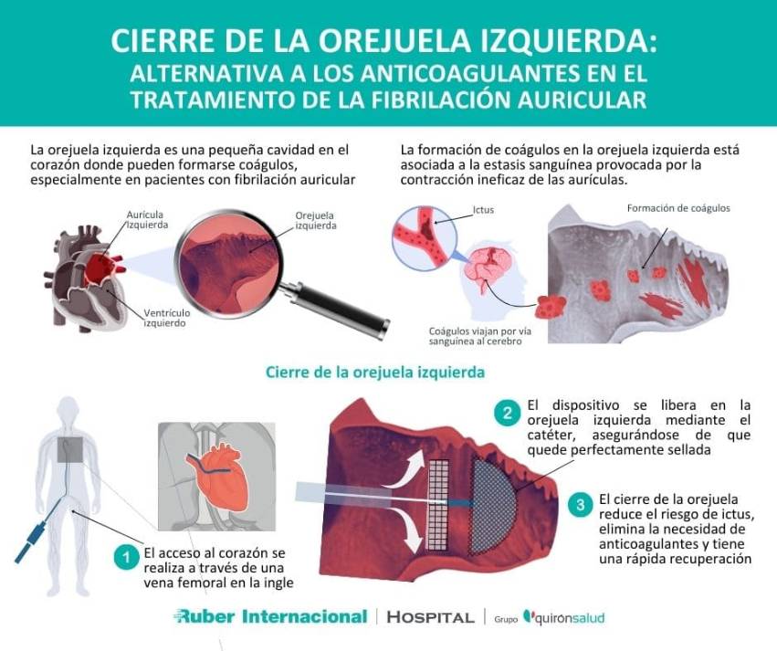 Tratamiento fibrilacion auriculas cierre percutaneo orejuela izquierda