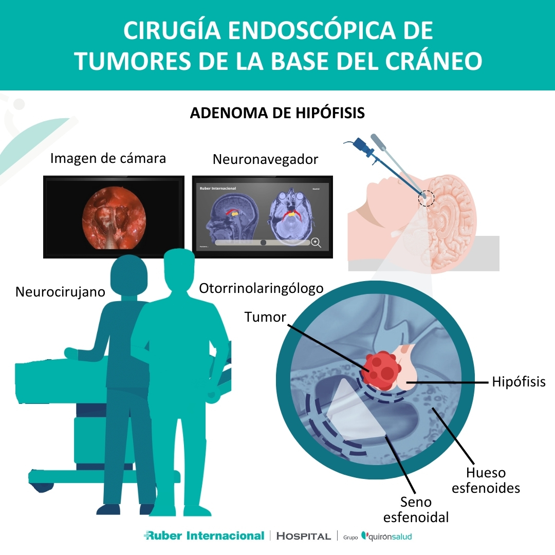 Cirugía Endoscópica de tumor de hipófisis en la base del cráneo