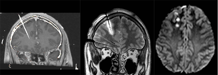 Epilepsia Termocoagulación