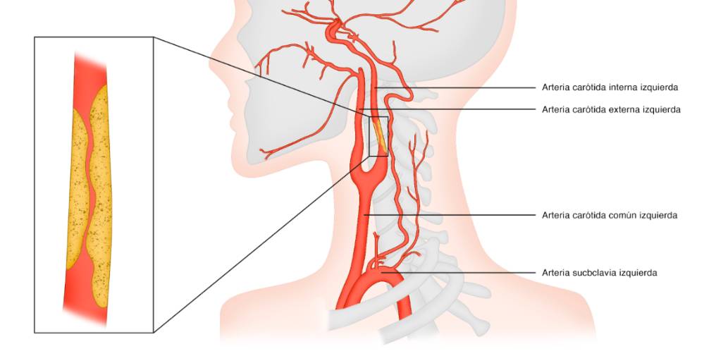 Estenosis Carotídea