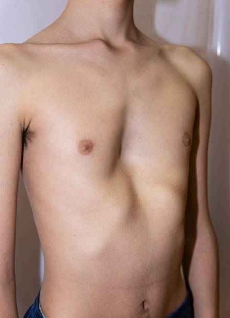 Pectus excavatum