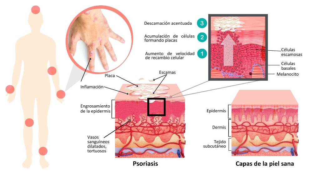 La Psoriasis Hospital Ruber Internacional