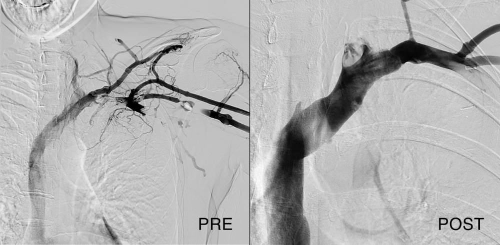 vena subclavia