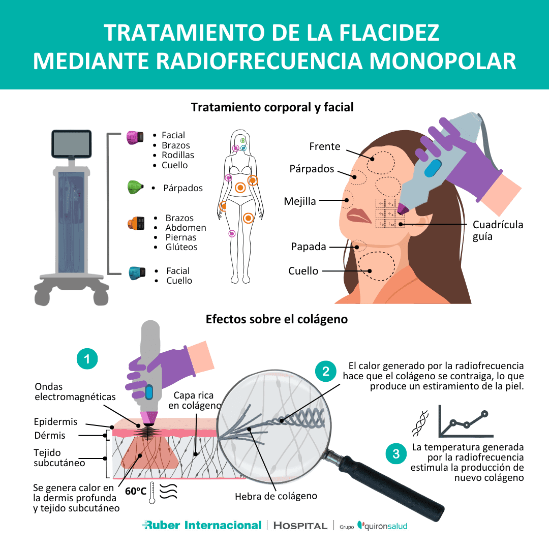 Cómo funciona la Radiofrecuencia facial