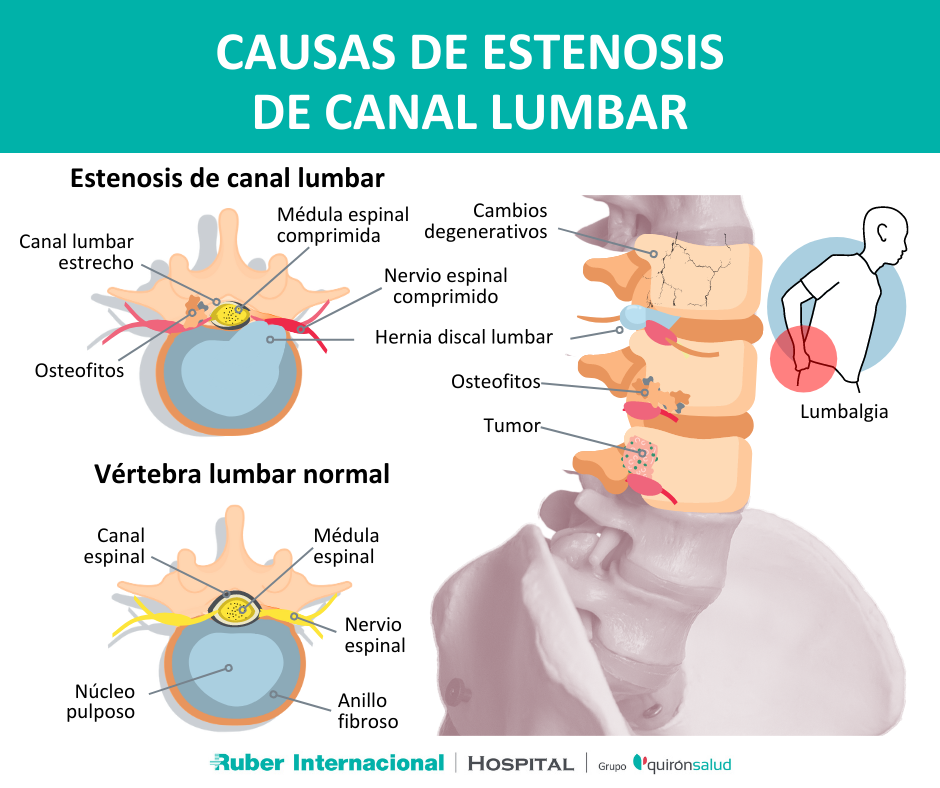 Causas de Estenosis de canal lumbar