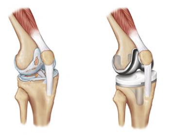 Rodilla