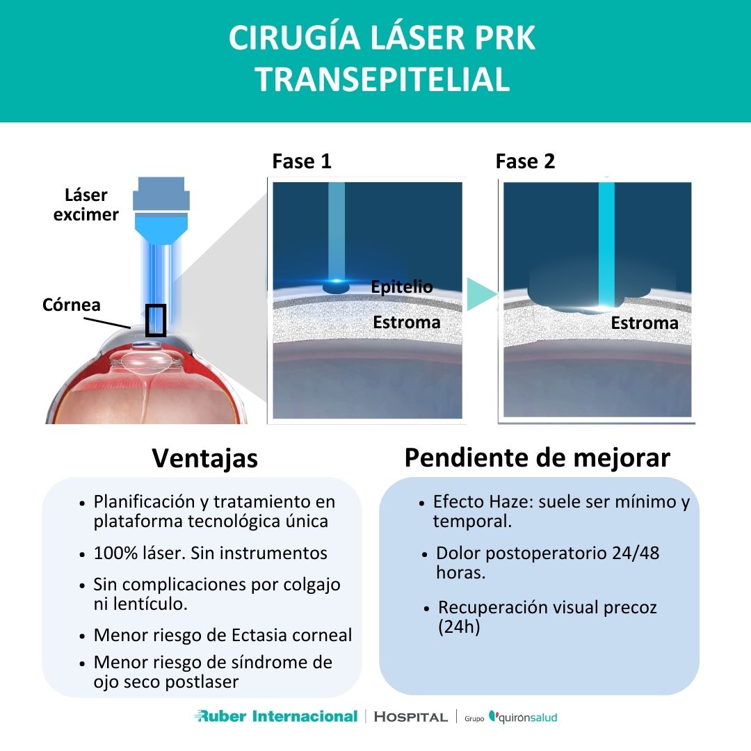 ventajas de la cirugía láser prk transepitelial (2)