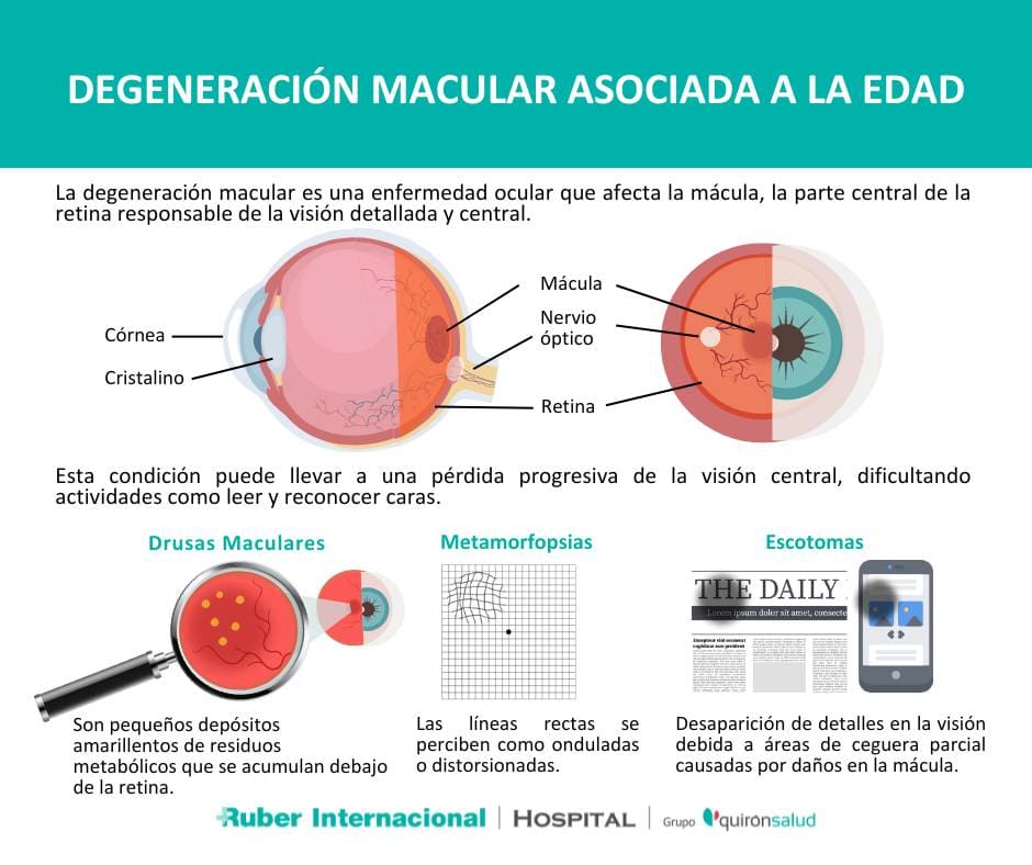 Degeneración Macular Definición Síntomas Tratamiento Diagnóstico Causas