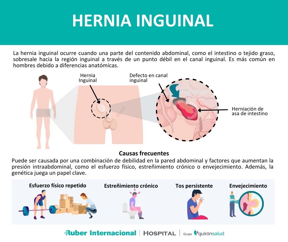 Que es Hernia Inguinal y sus causas